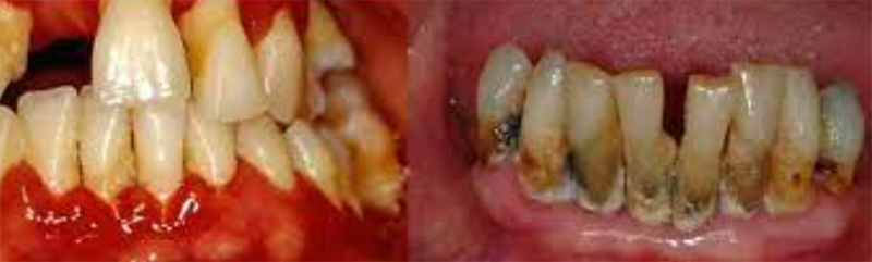 TCOCIA 10 抗牙石试验