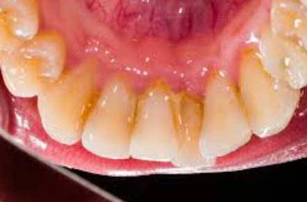 WS/T 326.3 牙膏的抑制牙菌斑和（或）减轻牙龈炎症的功效验证