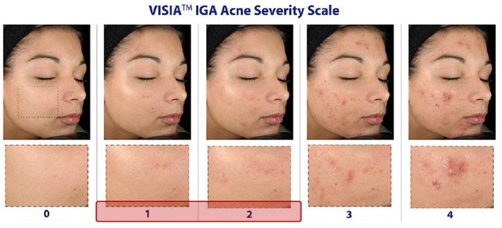 化妆品功效测试——抗痘与控油临床测试