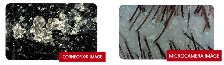 头皮组织及毛发产品——临床头屑评估