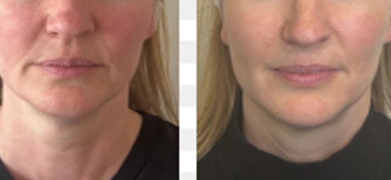 医美术后急护护肤品—即刻降温功效评价方案