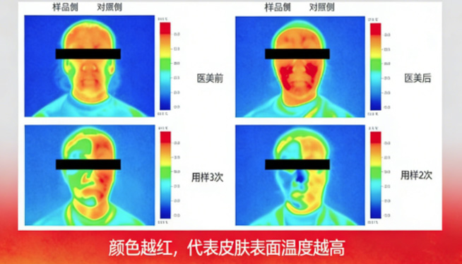 医美术后急护护肤品—即刻降温功效评价方案