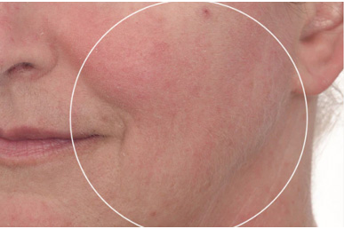 医美术后维稳护肤品——保湿和修护功效评价方案