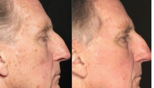 医美术后急护护肤品—防反黑功效评价方案