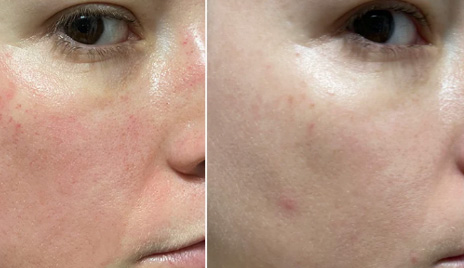 加乘延长医美效果护肤品—延长美白效果评价方案