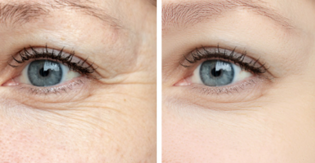 媲美医美效果护肤品——改善眼部皱纹、黑眼圈、眼袋效果评价方案