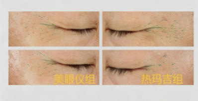 媲美医美效果护肤品——改善眼部皱纹、黑眼圈、眼袋效果评价方案