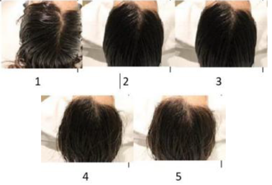 头皮组织及毛发产品——油性头皮皮脂分泌量的定量检测