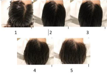 毛发及相关组织——头皮功效测试