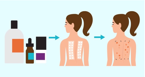 斑贴试验Patch test