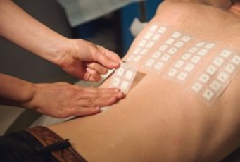 斑贴试验Patch test
