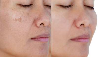 改善肤质与肤色功效临床测试（专于皮肤颜色变化评估）